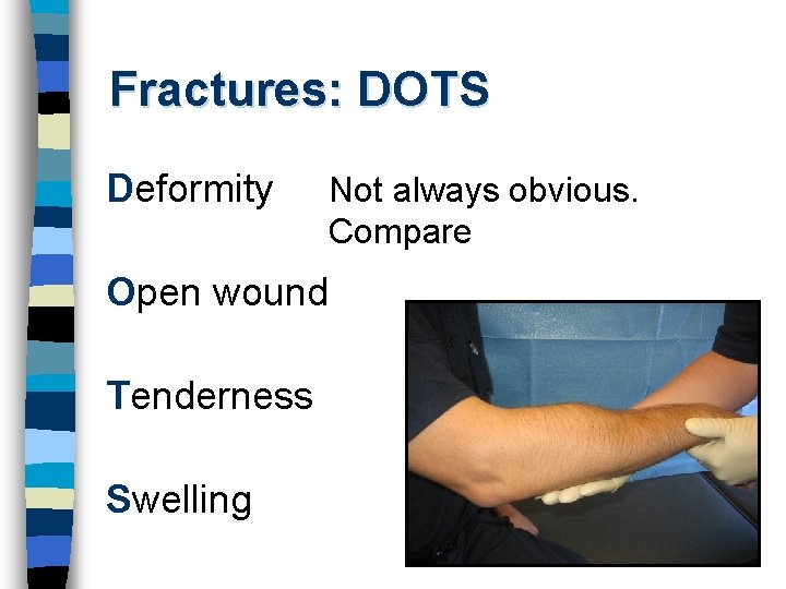 Fractures: DOTS Deformity Not always obvious. Compare Open wound Tenderness Swelling 
