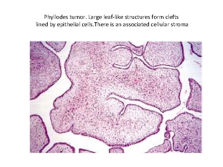 Phyllodes tumor. Large leaf-like structures form clefts lined by epithelial cells. There is an