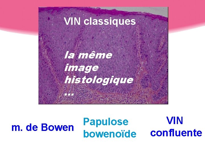 VIN classiques la même image histologique … Papulose m. de Bowen bowenoïde VIN confluente