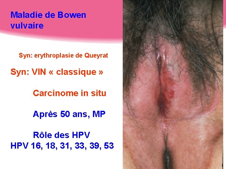 Maladie de Bowen vulvaire Syn: erythroplasie de Queyrat Syn: VIN « classique » Carcinome