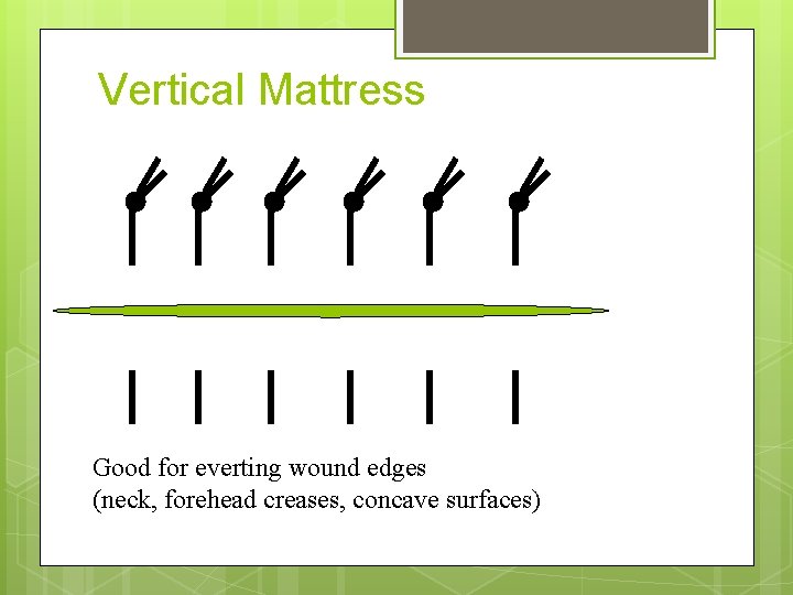 Vertical Mattress Good for everting wound edges (neck, forehead creases, concave surfaces) 