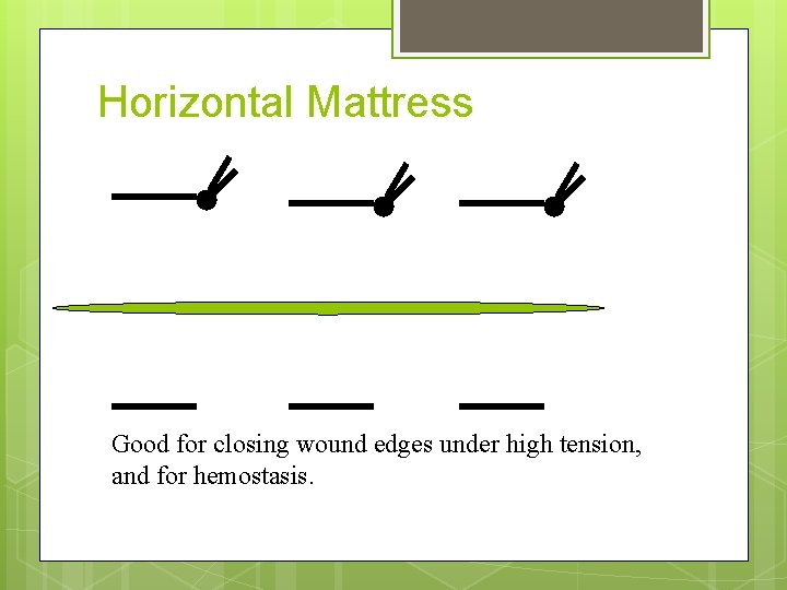 Horizontal Mattress Good for closing wound edges under high tension, and for hemostasis. 