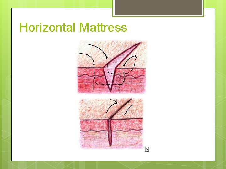 Horizontal Mattress 