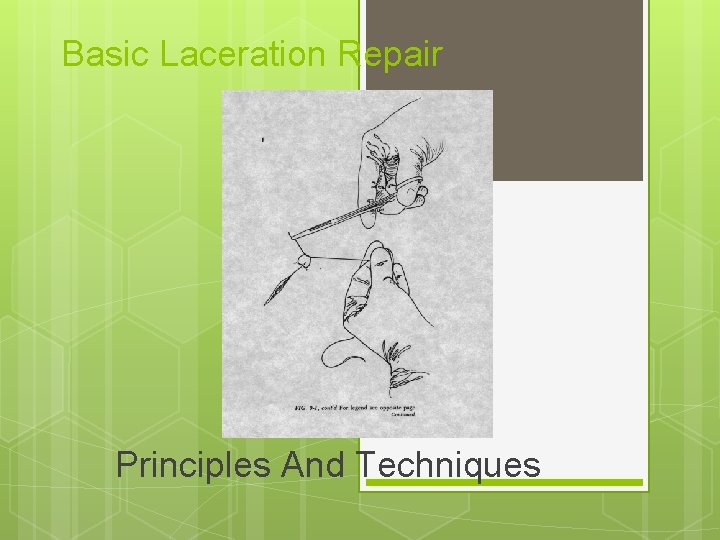 Basic Laceration Repair Principles And Techniques 