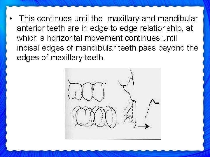  • This continues until the maxillary and mandibular anterior teeth are in edge