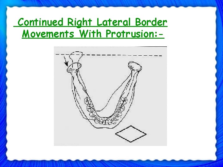 Continued Right Lateral Border Movements With Protrusion: 