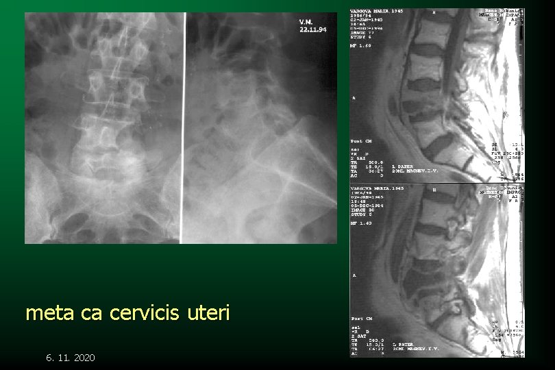 meta ca cervicis uteri 6. 11. 2020 