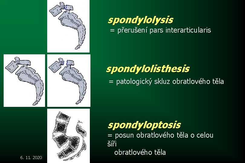 spondylolysis = přerušení pars interarticularis spondylolisthesis = patologický skluz obratlového těla spondyloptosis 6. 11.