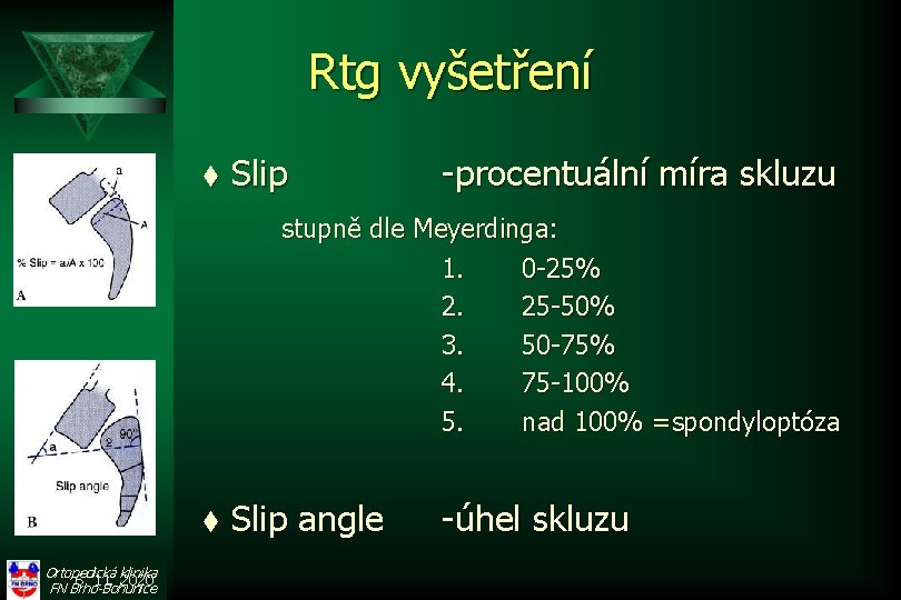 Rtg vyšetření t Slip -procentuální míra skluzu stupně dle Meyerdinga: 1. 0 -25% 2.
