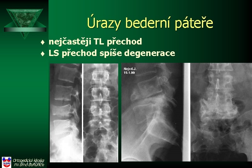 Úrazy bederní páteře t t Ortopedická klinika 6. 11. 2020 FN Brno-Bohunice nejčastěji TL