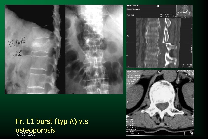 Fr. L 1 burst (typ A) v. s. osteoporosis 6. 11. 2020 
