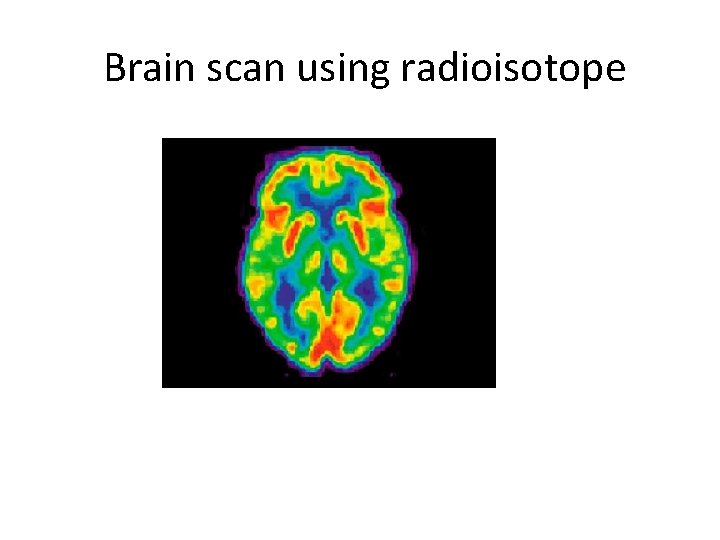 Brain scan using radioisotope 