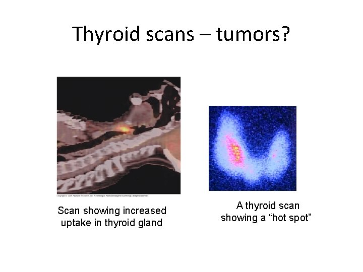 Thyroid scans – tumors? Scan showing increased uptake in thyroid gland A thyroid scan