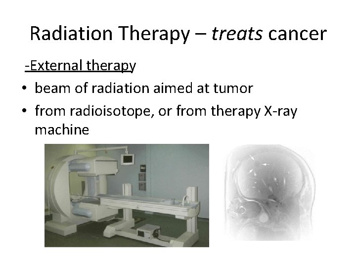 Radiation Therapy – treats cancer External therapy • beam of radiation aimed at tumor