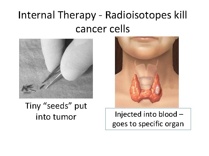 Internal Therapy Radioisotopes kill cancer cells Tiny “seeds” put into tumor Injected into blood