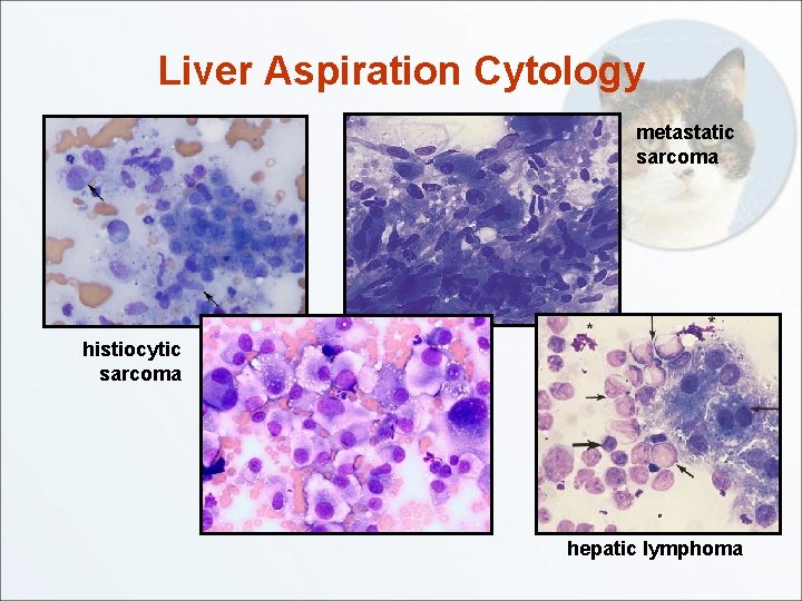 Liver Aspiration Cytology metastatic sarcoma histiocytic sarcoma hepatic lymphoma 