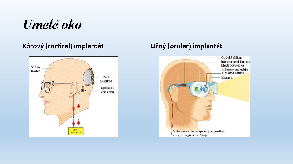 Umelé oko Kôrový (cortical) implantát Očný (ocular) implantát 