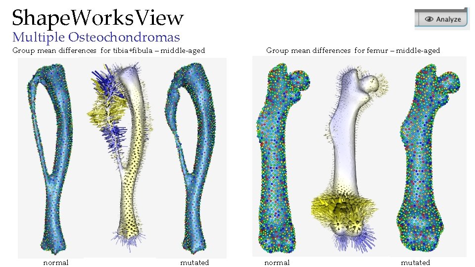 Shape. Works. View Multiple Osteochondromas Group mean differences for tibia+fibula – middle-aged normal mutated