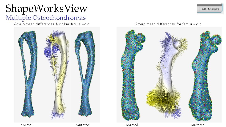 Shape. Works. View Multiple Osteochondromas Group mean differences for tibia+fibula – old normal mutated