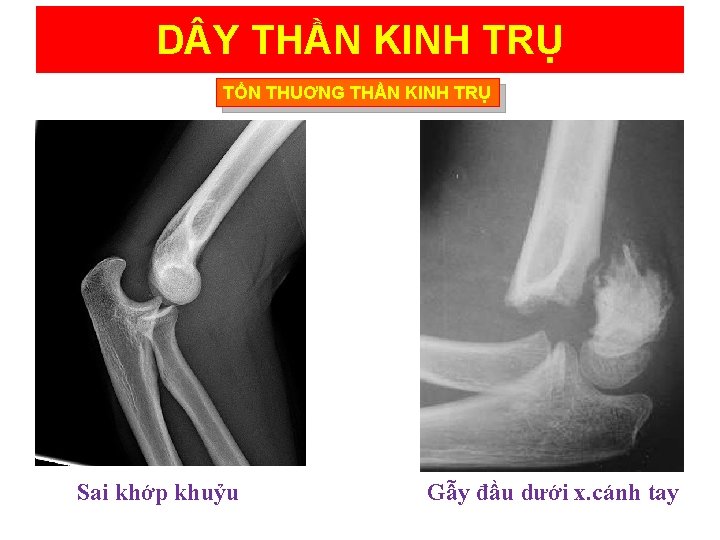 D Y THẦN KINH TRỤ TỔN THUƠNG THẦN KINH TRỤ Sai khớp khuỷu Gẫy