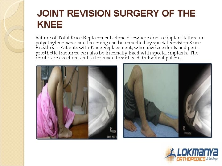 JOINT REVISION SURGERY OF THE KNEE Failure of Total Knee Replacements done elsewhere due