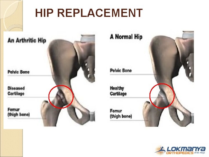 HIP REPLACEMENT 