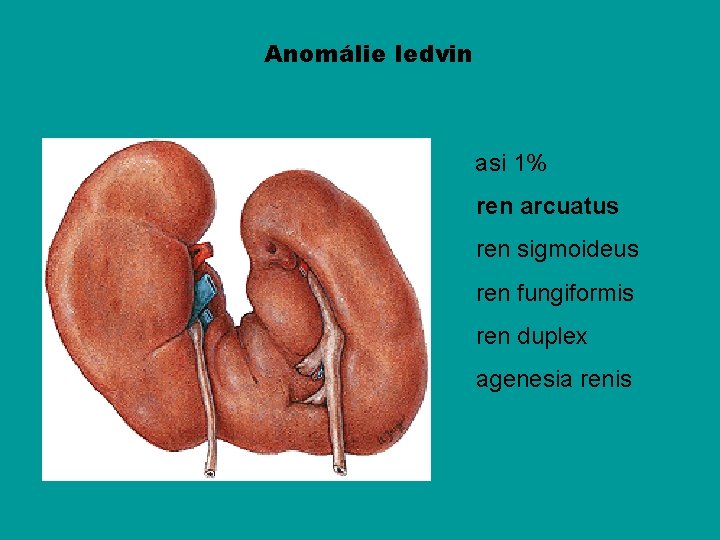 Anomálie ledvin asi 1% ren arcuatus ren sigmoideus ren fungiformis ren duplex agenesia renis