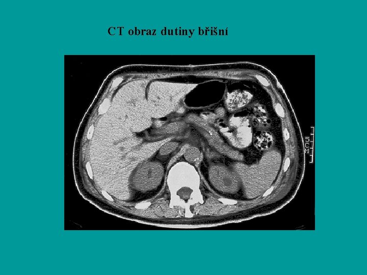 CT obraz dutiny břišní 