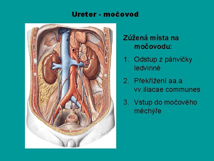 Ureter - močovod Zúžená místa na močovodu: 1. Odstup z pánvičky ledvinné 2. Překřížení