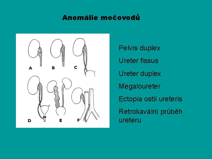 Anomálie močovodů Pelvis duplex Ureter fissus Ureter duplex Megaloureter Ectopia ostii ureteris Retrokavální průběh