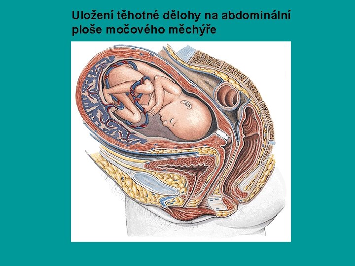 Uložení těhotné dělohy na abdominální ploše močového měchýře 