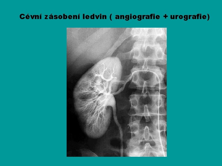 Cévní zásobení ledvin ( angiografie + urografie) 