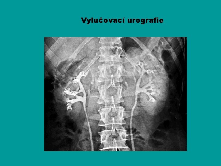 Vylučovací urografie 