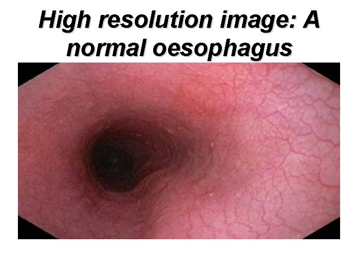 High resolution image: A normal oesophagus 