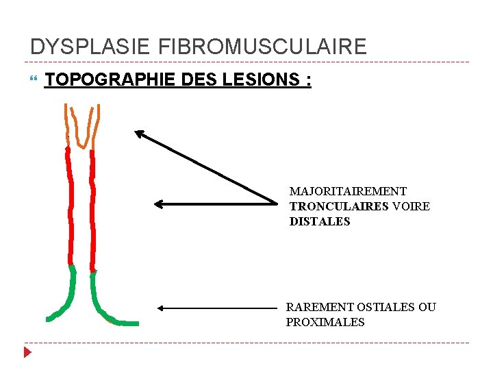 DYSPLASIE FIBROMUSCULAIRE TOPOGRAPHIE DES LESIONS : MAJORITAIREMENT TRONCULAIRES VOIRE DISTALES RAREMENT OSTIALES OU PROXIMALES