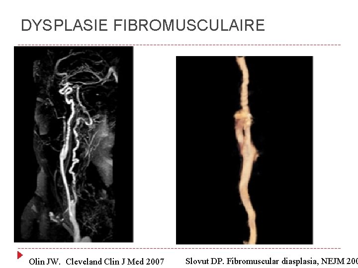 DYSPLASIE FIBROMUSCULAIRE Olin JW. Cleveland Clin J Med 2007 Slovut DP. Fibromuscular diasplasia, NEJM