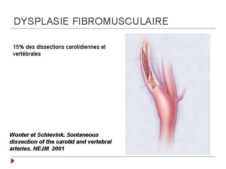 DYSPLASIE FIBROMUSCULAIRE 15% des dissections carotidiennes et vertébrales Wonter et Schievink. Sontaneous dissection of