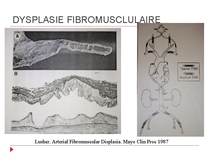 DYSPLASIE FIBROMUSCLULAIRE Lusher. Arterial Fibromuscular Displasia. Mayo Clin Proc 1987 