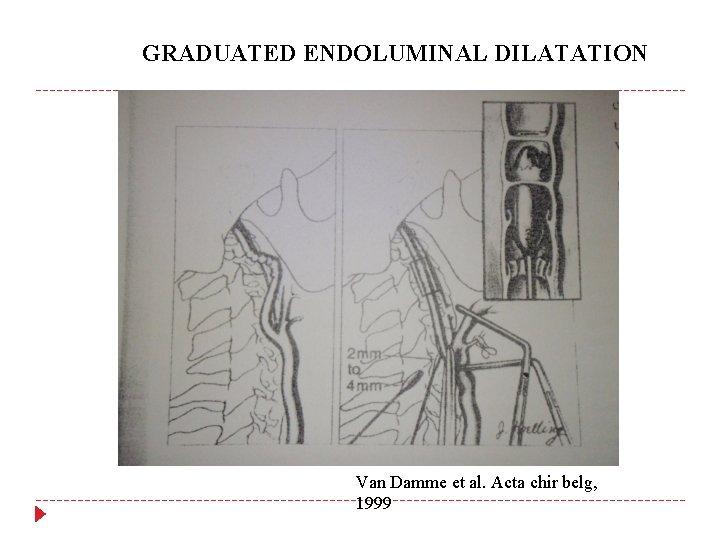 GRADUATED ENDOLUMINAL DILATATION Van Damme et al. Acta chir belg, 1999 