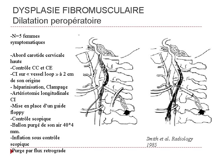 DYSPLASIE FIBROMUSCULAIRE Dilatation peropératoire -N=5 femmes symptomatiques -Abord carotide cervicale haute -Contrôle CC et