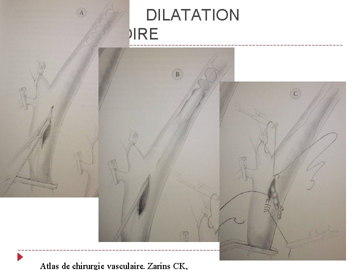  DILATATION PEROPERATOIRE Atlas de chirurgie vasculaire. Zarins CK, 