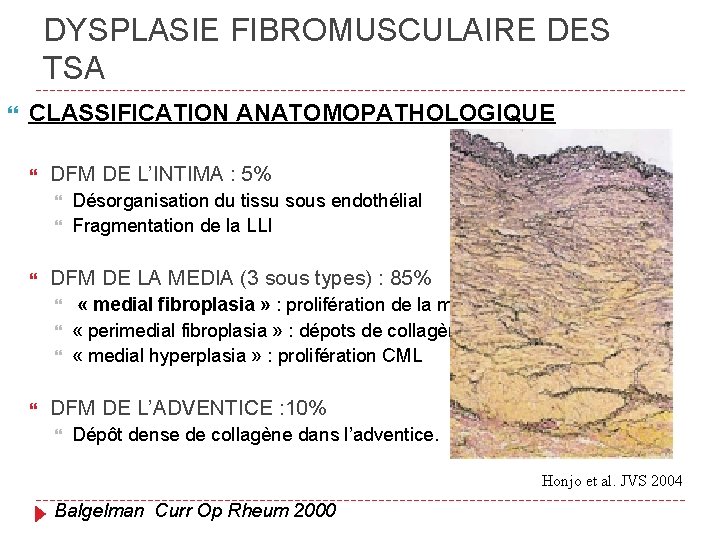 DYSPLASIE FIBROMUSCULAIRE DES TSA CLASSIFICATION ANATOMOPATHOLOGIQUE DFM DE L’INTIMA : 5% DFM DE LA