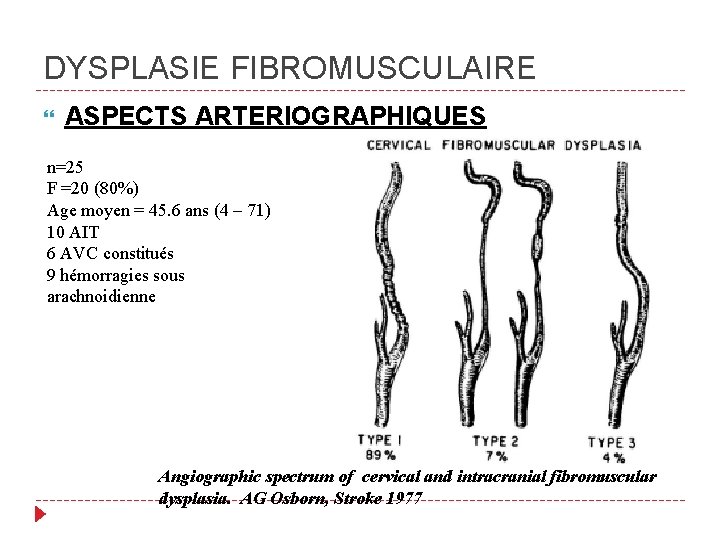 DYSPLASIE FIBROMUSCULAIRE ASPECTS ARTERIOGRAPHIQUES n=25 F =20 (80%) Age moyen = 45. 6 ans