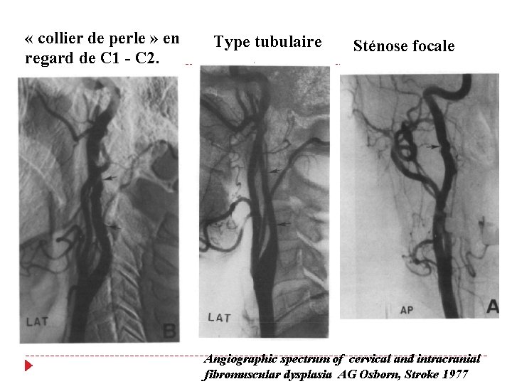  « collier de perle » en regard de C 1 - C 2.