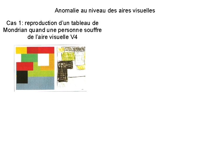 Anomalie au niveau des aires visuelles Cas 1: reproduction d’un tableau de Mondrian quand