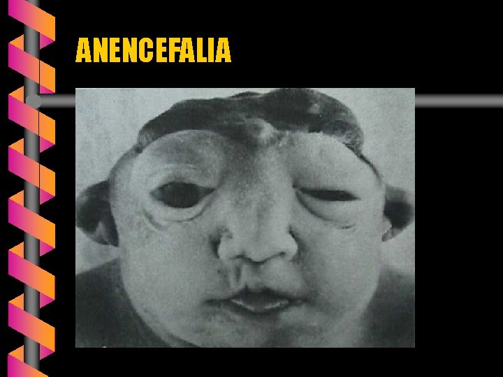 ANENCEFALIA 