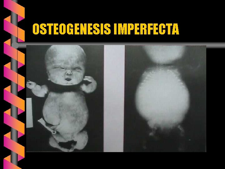 OSTEOGENESIS IMPERFECTA 