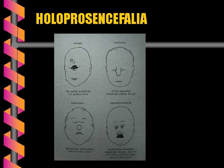 HOLOPROSENCEFALIA 