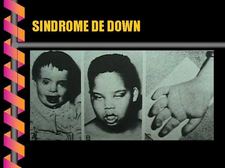 SINDROME DE DOWN 