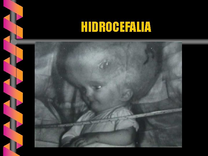 HIDROCEFALIA 